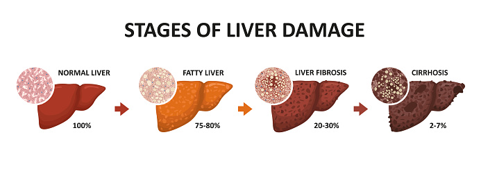 Liver Fibrosis vs. Cirrhosis: Understanding the Progression